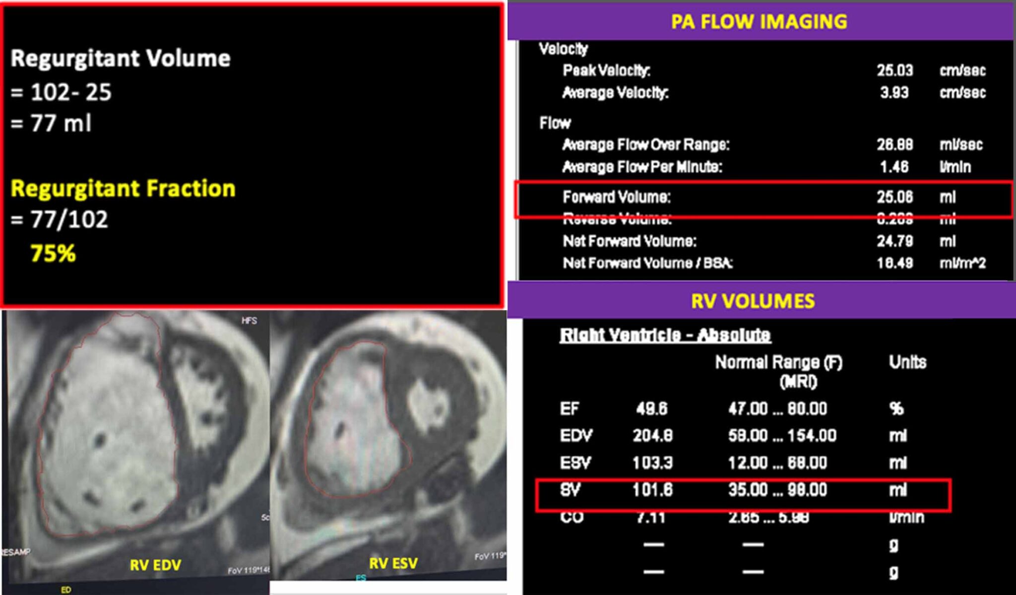 Case Of An Isolated Tricuspid Valve Regurgitation Presenting As Right