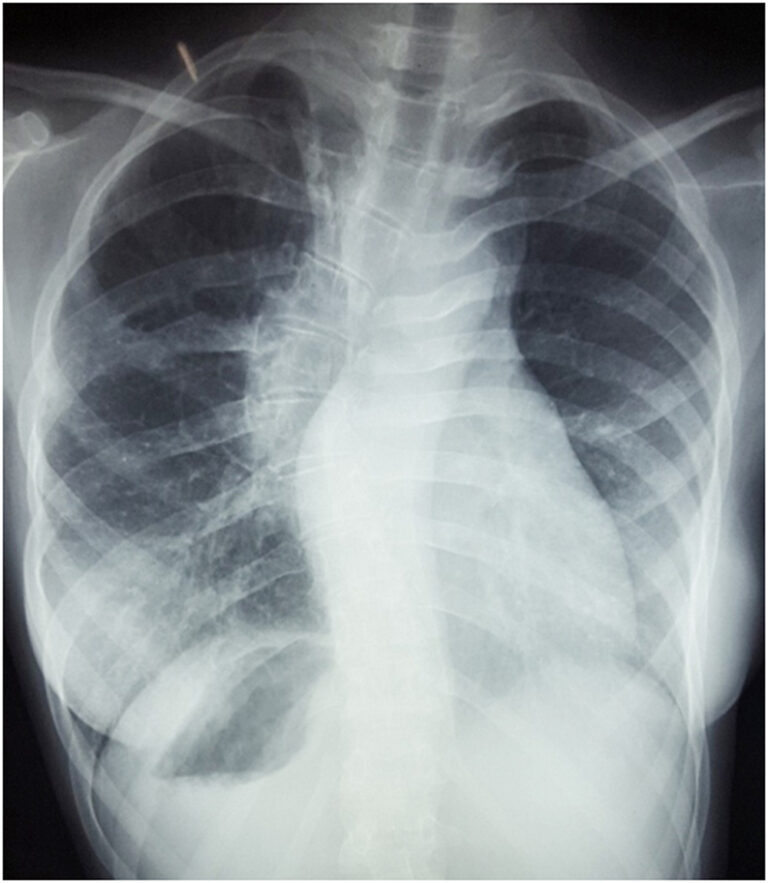 Complex Congenital Heart Disease: A Rare Case of Situs Inversus with ...