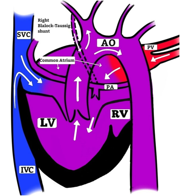 Complex Congenital Heart Disease: A Rare Case of Situs Inversus with ...