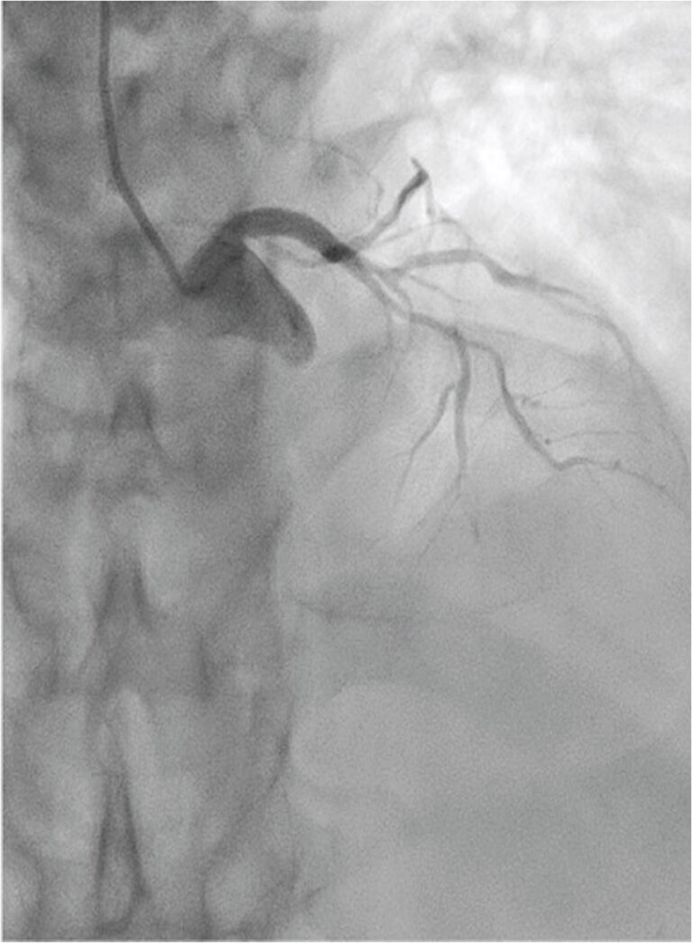 Rotational Atherectomy in Acute ST-Elevation Myocardial Infarction ...