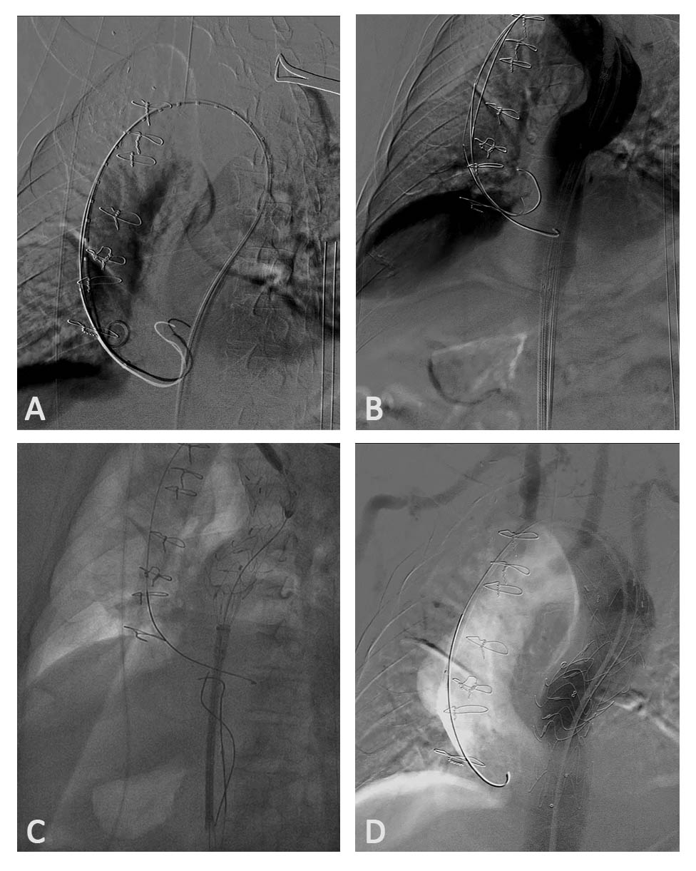 A Rare Case of an Ascending Aorta and Aortic Arch Aneurysm with an ...