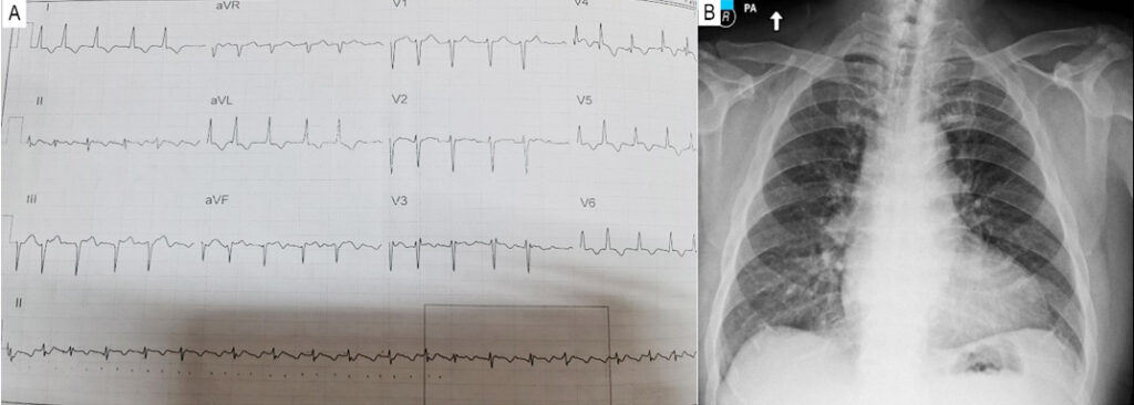 Apical Aneurysms and Mid–Left Ventricular Obstruction in Hypertrophic  Cardiomyopathy