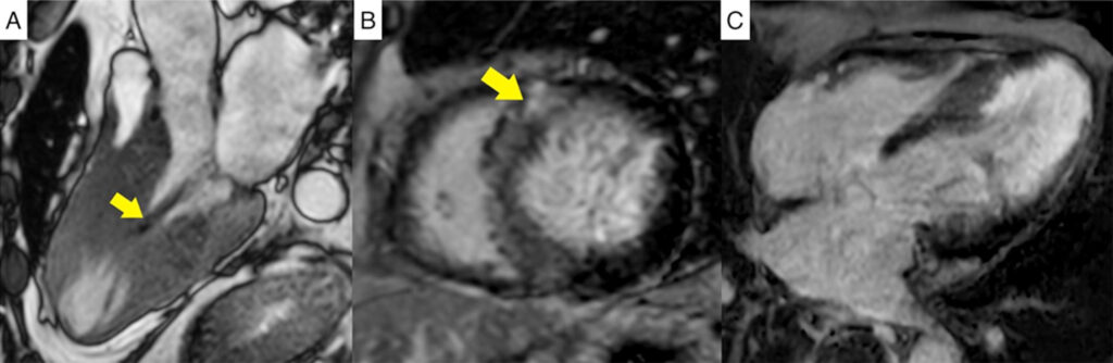 Apical Aneurysms and Mid–Left Ventricular Obstruction in Hypertrophic  Cardiomyopathy