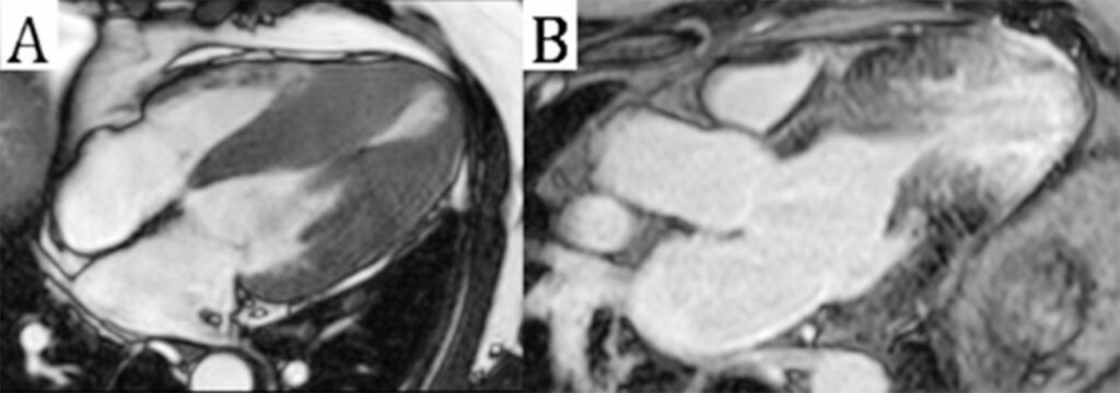 Apical Aneurysms and Mid–Left Ventricular Obstruction in Hypertrophic  Cardiomyopathy