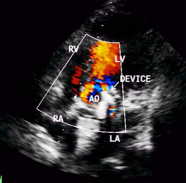 Device Closure Of Aortic Paravalvular Leak – Asean Heart Journal