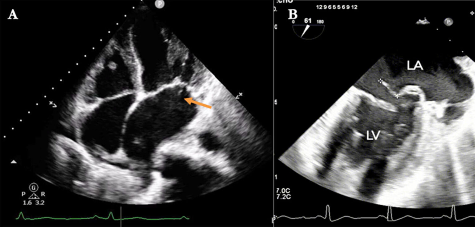 Successful Minimally Invasive Mitral Valve Replacement in a Post ...