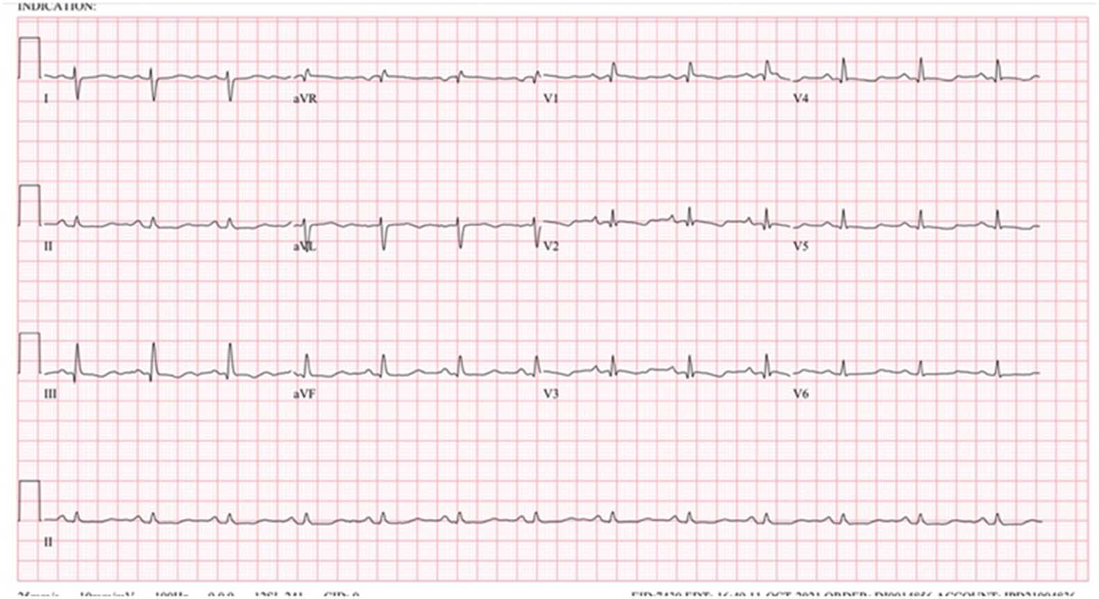 Case of An Isolated Tricuspid Valve Regurgitation Presenting as Right